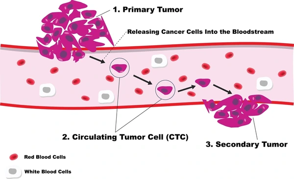 Diagram showing circulating tumor cells among normal blood cells in the bloodstream