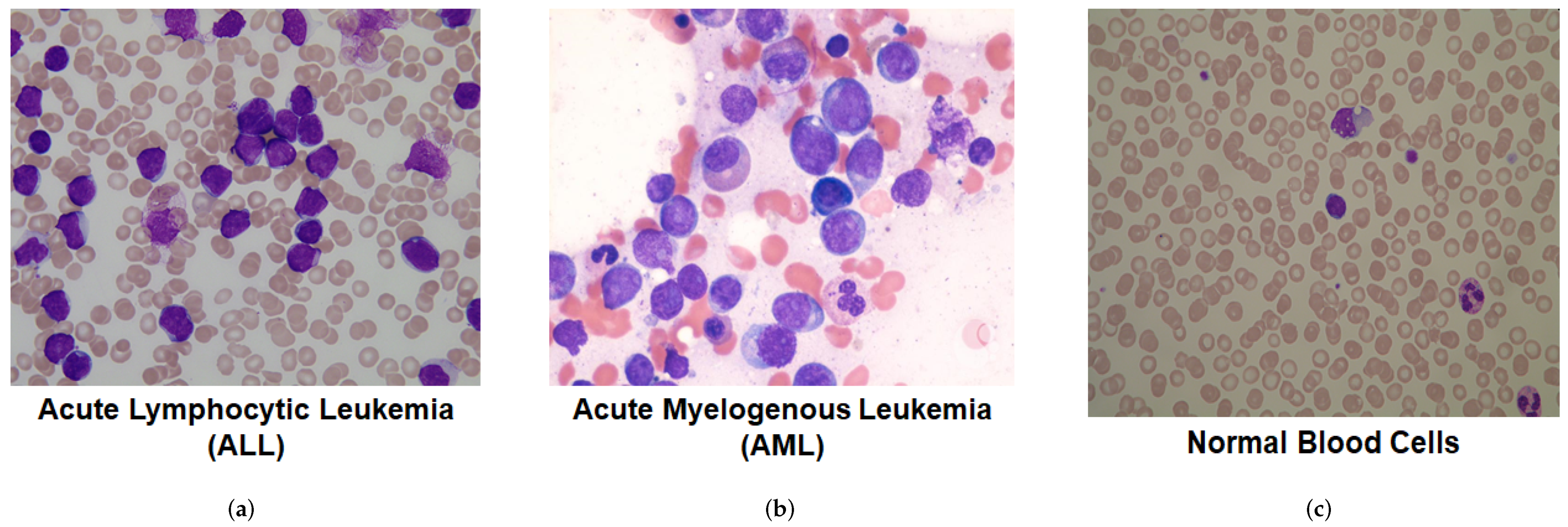 Microscope image showing a highlighted cancer cell detected by AI among normal blood cells